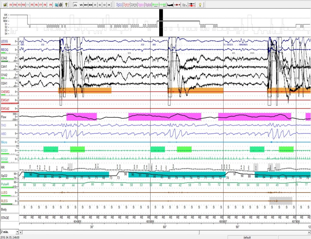 Obstruktív alvási apnoé esemény egy poliszomnográfiás felvételen